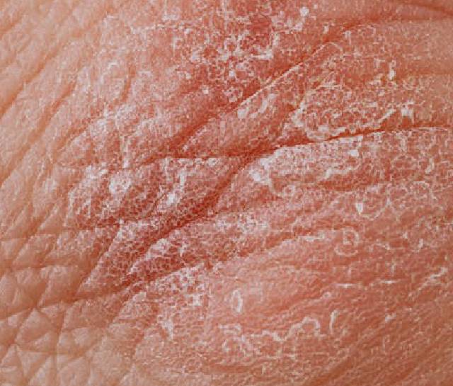 Hautausschlag (Epidermis) mit Juckreiz